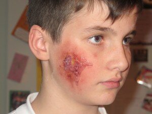 Prosthetics Club